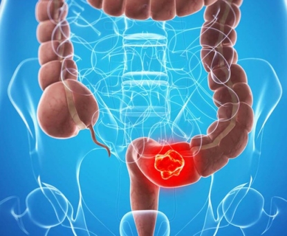 Tổng quan bệnh ung thư đại tràng